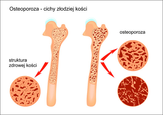 „NIE ŁAM SIĘ” - Fundacja Jesteśmy Blisko organizuje wielkie, bezpłatne badanie kości! Dzięki nowoczesnej metodzie densytometrii można szybko i zupełnie bezboleśnie sprawdzić stan swoich kości i zapobiec rozwojowi choroby